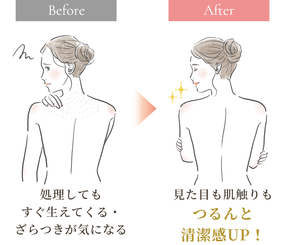 Before 処理してもすぐ生えてくる・ざらつきが気になる After 見た目も肌触りもつるんと清潔感UP!